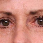 Eyelid Surgery Before & After Patient #1509