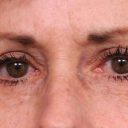 Eyelid Surgery Before & After Patient #1509