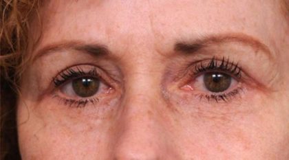 Eyelid Surgery Before & After Patient #1509