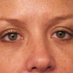 Eyelid Surgery Before & After Patient #1514