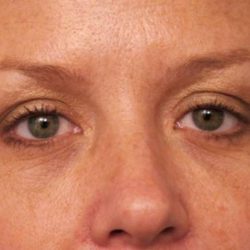 Eyelid Surgery Before & After Patient #1514
