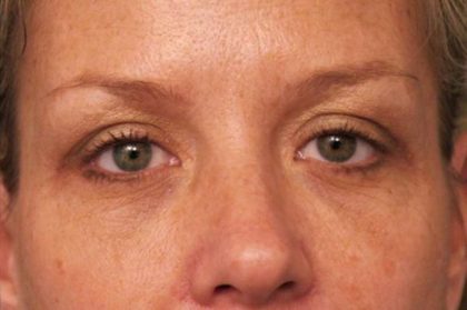 Eyelid Surgery Before & After Patient #1514