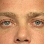 Eyelid Surgery Before & After Patient #1519