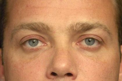 Eyelid Surgery Before & After Patient #1519
