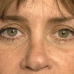 Eyelid Surgery Before & After Patient #1525
