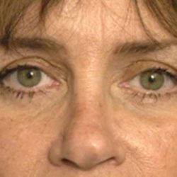 Eyelid Surgery Before & After Patient #1525