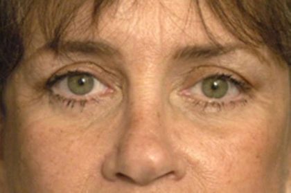 Eyelid Surgery Before & After Patient #1525