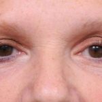 Eyelid Surgery Before & After Patient #1530