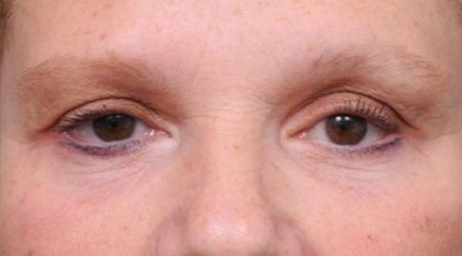Eyelid Surgery Before & After Patient #1530