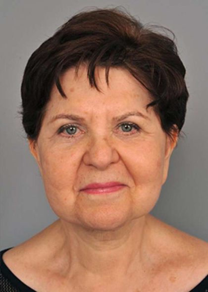 Eyelid Surgery Before & After Patient #1540