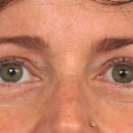 Eyelid Surgery Before & After Patient #1550