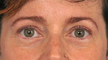 Eyelid Surgery Before & After Patient #1550