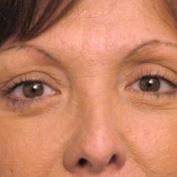 Eyelid Surgery Before & After Patient #1557
