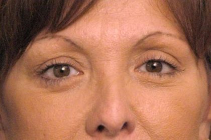 Eyelid Surgery Before & After Patient #1557