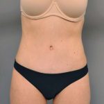 Tummy Tuck Before & After Patient #354