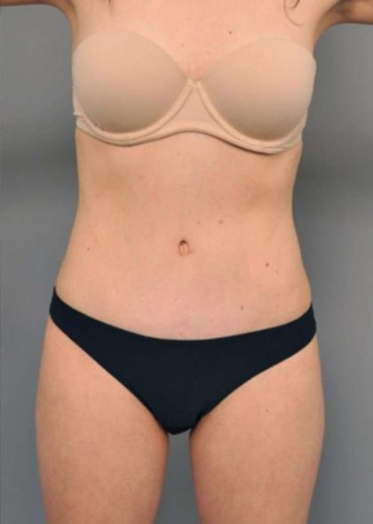Tummy Tuck Before & After Patient #354