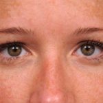 Eyelid Surgery Before & After Patient #1565