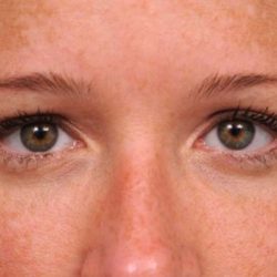 Eyelid Surgery Before & After Patient #1565