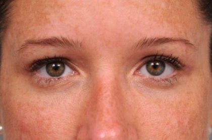 Eyelid Surgery Before & After Patient #1565