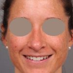 Rhinoplasty Before & After Patient #1572