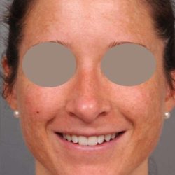 Rhinoplasty Before & After Patient #1572