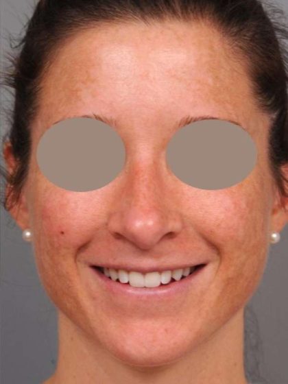 Rhinoplasty Before & After Patient #1572