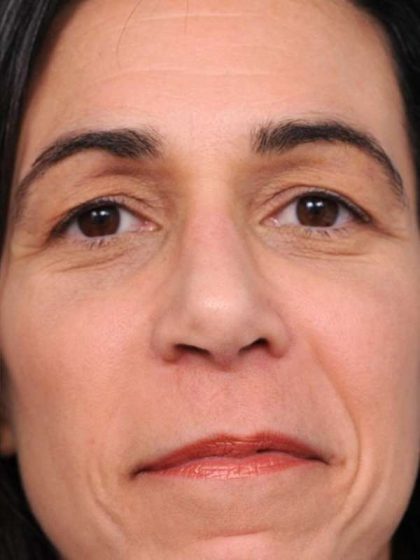 Rhinoplasty Before & After Patient #1586