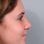 Rhinoplasty Before & After Patient #1591