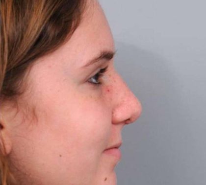 Rhinoplasty Before & After Patient #1591