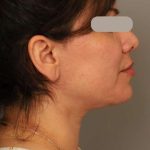 Neck Lift (Traditional) Before & After Patient #1596