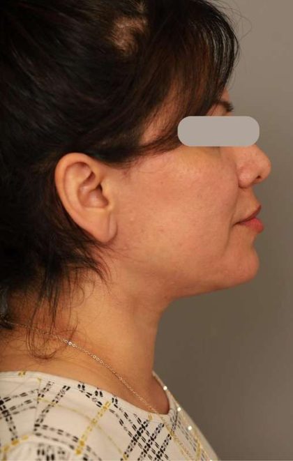 Neck Lift (Traditional) Before & After Patient #1596