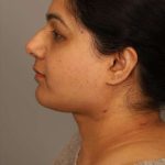 Neck Lift (Traditional) Before & After Patient #1605