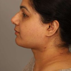 Neck Lift (Traditional) Before & After Patient #1605