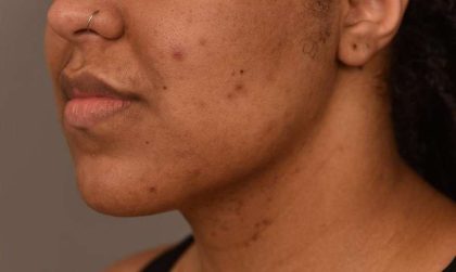 Neck Lift (Traditional) Before & After Patient #1621