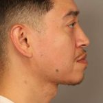 Mini Neck Lift (Single Incision) Before & After Patient #1630