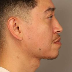 Mini Neck Lift (Single Incision) Before & After Patient #1630