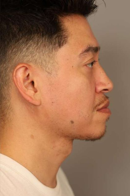 Mini Neck Lift (Single Incision) Before & After Patient #1630
