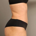 Tummy Tuck Before & After Patient #238