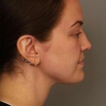 Mini Neck Lift (Single Incision) Before & After Patient #1637
