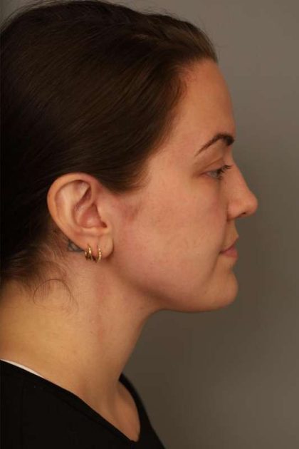 Mini Neck Lift (Single Incision) Before & After Patient #1637