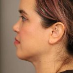 Mini Neck Lift (Single Incision) Before & After Patient #1646