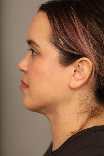 Mini Neck Lift (Single Incision) Before & After Patient #1646