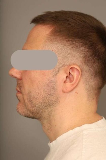 Mini Neck Lift (Single Incision) Before & After Patient #1653