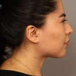 Mini Neck Lift (Single Incision) Before & After Patient #1662