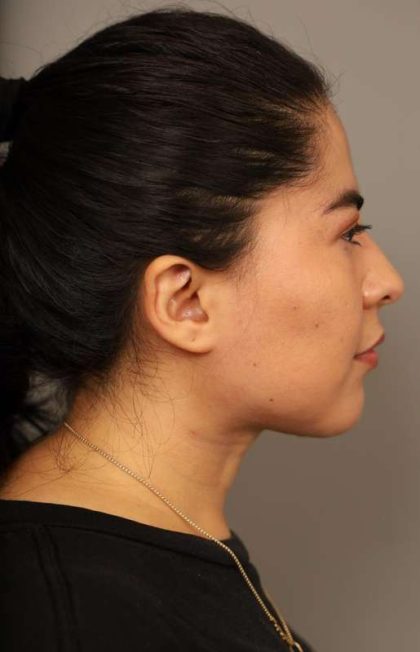 Mini Neck Lift (Single Incision) Before & After Patient #1662
