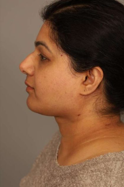 Mini Neck Lift (Single Incision) Before & After Patient #1671