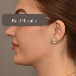 Mini Neck Lift (Single Incision) Before & After Patient #1674