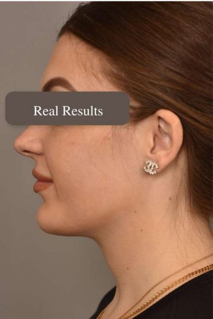 Mini Neck Lift (Single Incision) Before & After Patient #1674