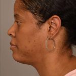 Mini Neck Lift (Single Incision) Before & After Patient #1679