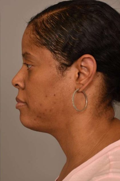 Mini Neck Lift (Single Incision) Before & After Patient #1679